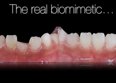 Odontología restauradora proceso de biomimética